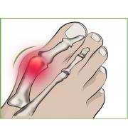 Locītavas aizsargs deformētam īkšķim (hallux valgus) ar gēla spilventiņu 
