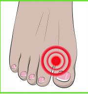 Pirkstu atdalītājs, aizsardzība īkšķa deformācijas gadījumā (hallux valgus) 1 pāris